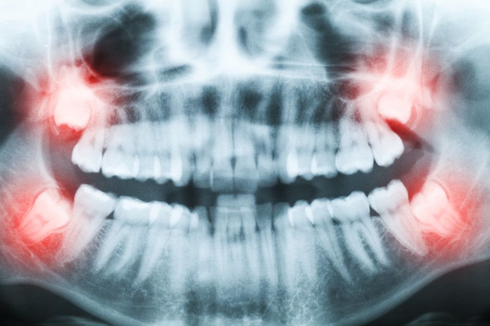 X-ray of the jaw highlighting wisdom teeth in red