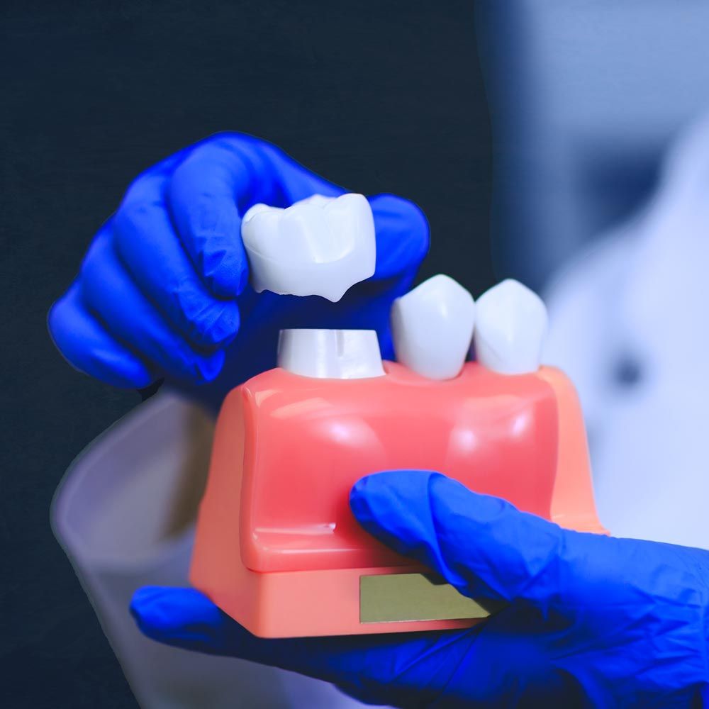Model of dental crown and jawbone