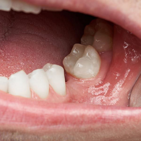 Smile with missing tooth