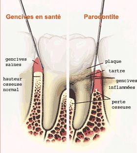 Illustration of tooth in the jaw